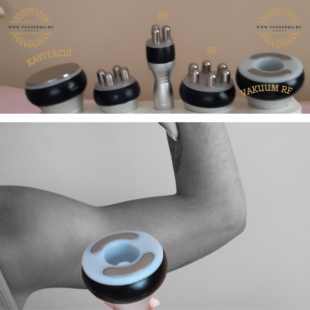 Rádiófrekvenciás zsírbontás