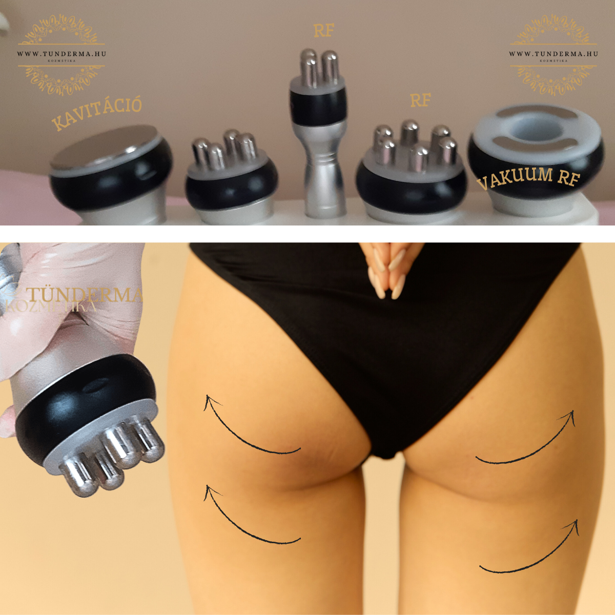 Rádiófrekvenciás cellulit kezelés