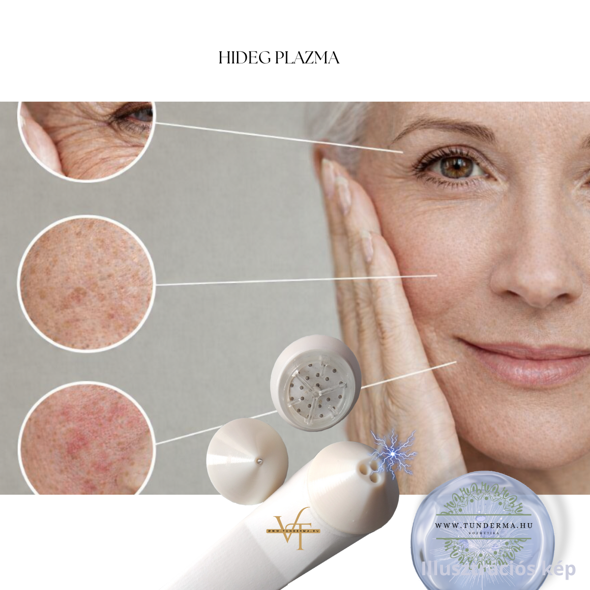 Pigmentfolt kezelés & Hideg plazma gép