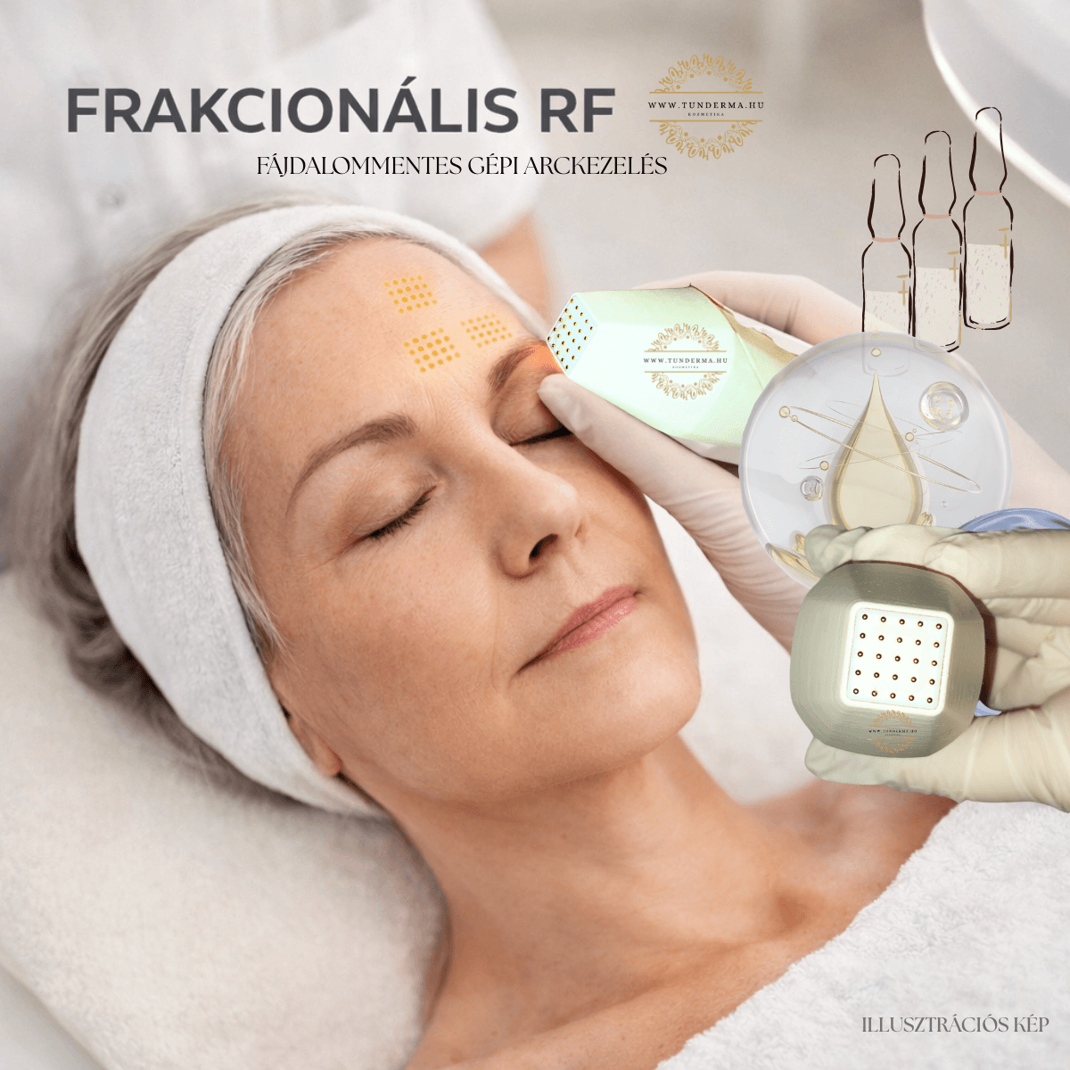Mátrixpontos RF Arckezelés ILLUSZTÁCIÓS KÉPE